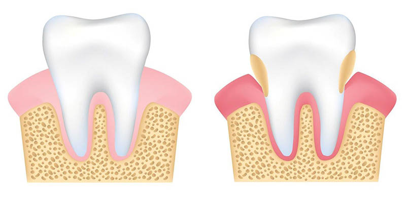 Viêm lợi là bệnh lý răng miệng không thể chủ quan