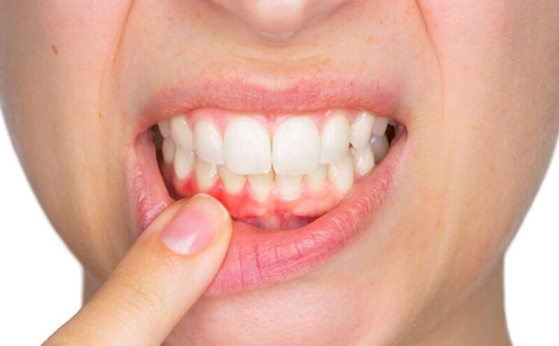Người bị sưng lợi nổi hạch cũng do viêm nướu răng gây ra