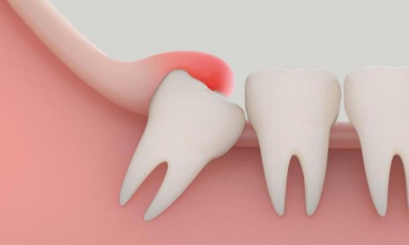 Viêm lợi mưng mủ là một trong những biểu hiện của người bệnh đang trong quá trình mọc răng khôn
