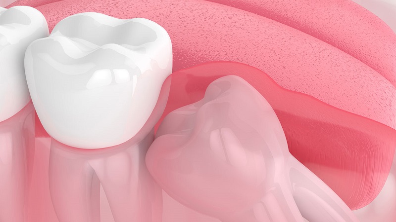 Viêm lợi trùm là tình trạng khiến răng mọc kẹt bên trong lợi