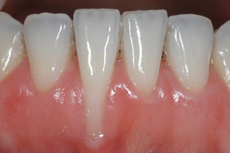 Khi người bệnh bị  viêm lợi tụt chân răng ở mức độ nhẹ thường ít quan tâm