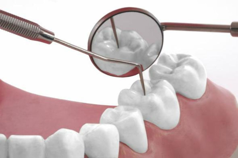 Một trong những cách điều trị viêm lợi tụt lợi là phủ mặt răng Composite