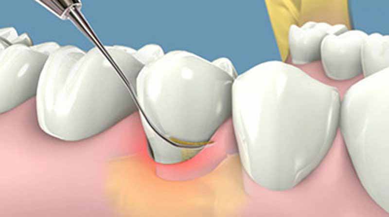 Đa số các trường hợp đều sẽ được chỉ định lấy vôi răng và dùng kháng sinh