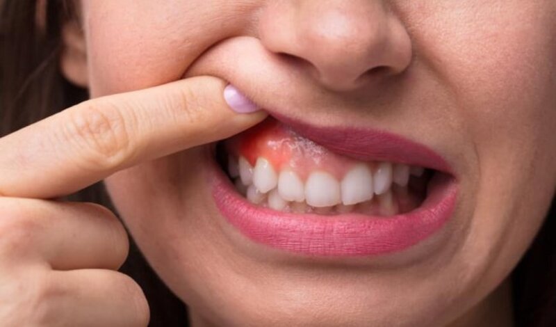 Bất kỳ ai bị viêm nha chu thường gặp một trong những dấu hiệu đầu tiên là viêm nướu răng