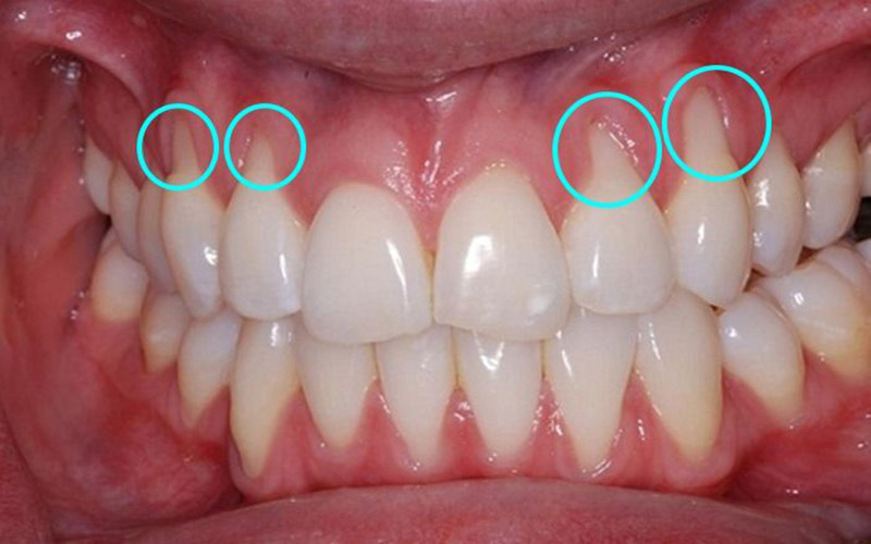 Viêm nướu răng sứ là bệnh lý răng miệng thường gặp
