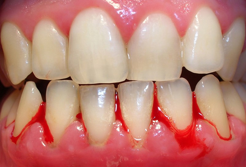 Viêm nướu răng sứ: Nguyên nhân và cách điều trị triệt để nhất