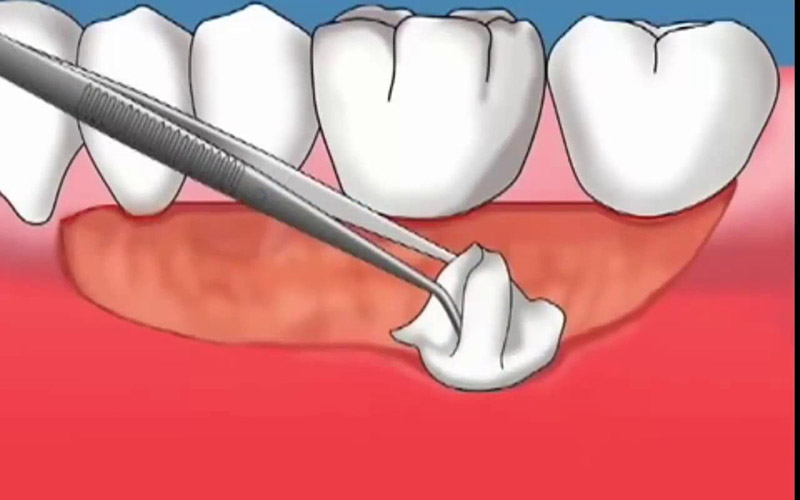 Cắt ghép lợi là một trong những thủ thuật nha khoa trong điều trị viêm nướu răng sứ