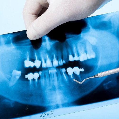 Máy chụp X quang giúp cung cấp hình ảnh răng miệng chi tiết và rõ nét nhất