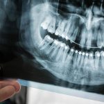 Niềng răng có chụp X-quang được không? Lưu ý gì khi thực hiện?