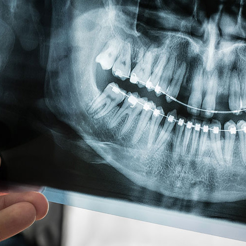 Niềng răng hoàn toàn có thể chụp X-quang
