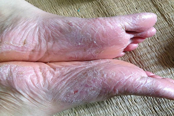 Hình ảnh viêm da cơ địa ở bàn chân