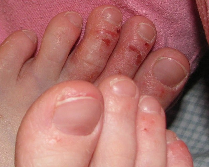 Hình ảnh viêm da cơ địa ở ngón chân